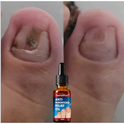 Suero Antihongos RELIEF OIL